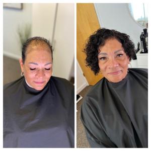 Hair Replacement Client